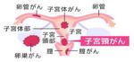 子宮頸がん　Womb cervix cancer
